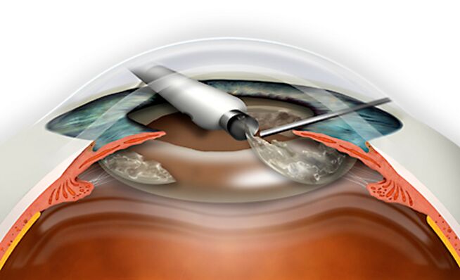 The replacement for refraction of the lens is carried out by micronadle, which excludes blood loss