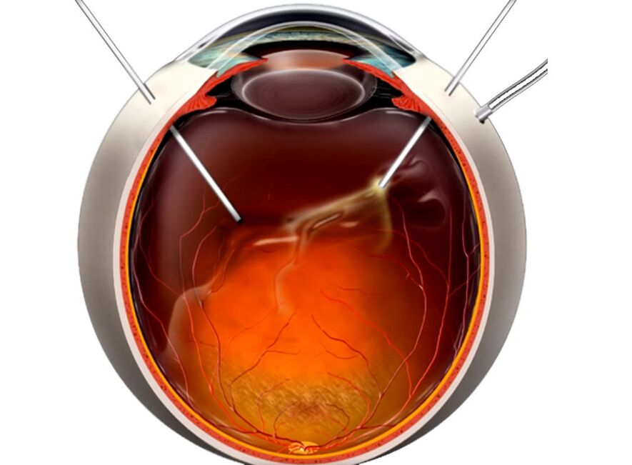 Vitrectomy - A procedure shown to people during retinal exfoliation